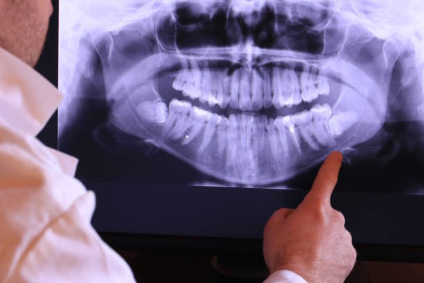 Best Emergency Tooth Extraction in Bellingham, WA
