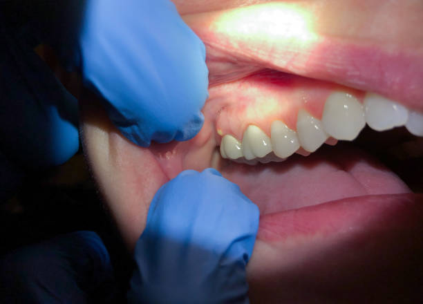 Best Emergency Gum Treatment in Bellingham, WA
